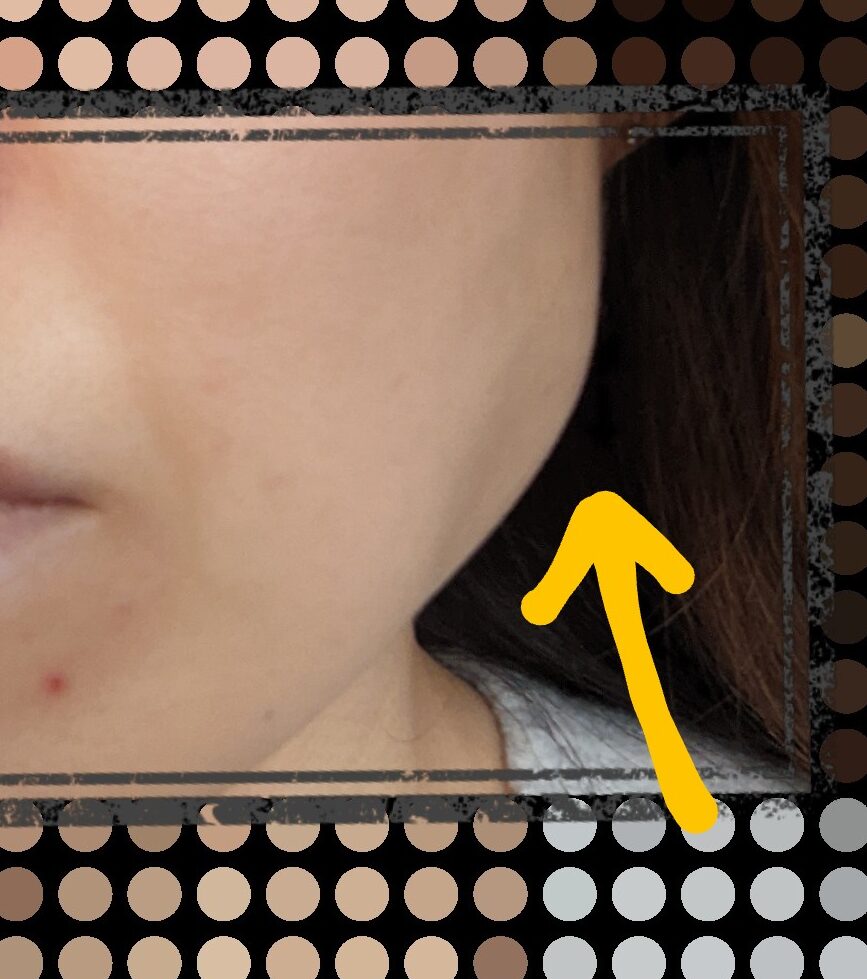 ボトックス翌日