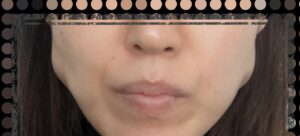 ボトックス13日目