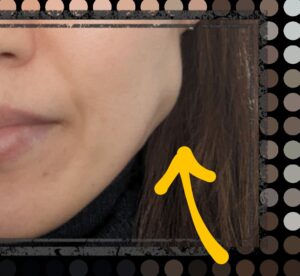 ボトックス13日目2